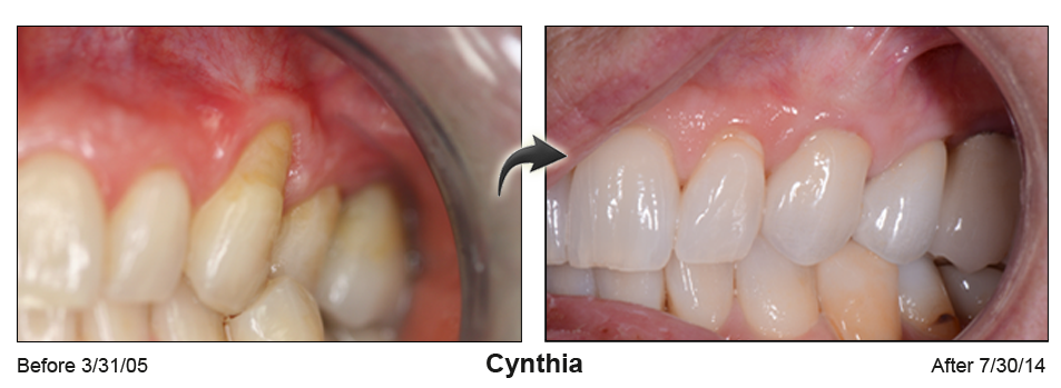 Cynthia - before and after pinhole surgical technique.