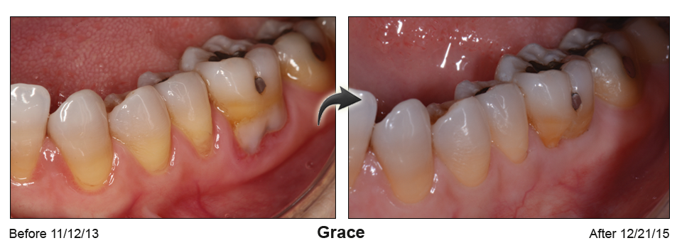 Grace - before and after pinhole surgical technique.