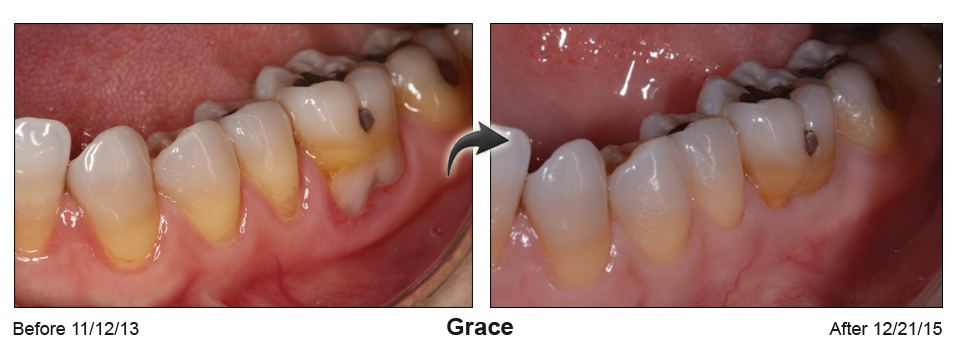 Grace - before and after pinhole surgical technique.