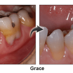 Grace - before and after pinhole surgical technique.