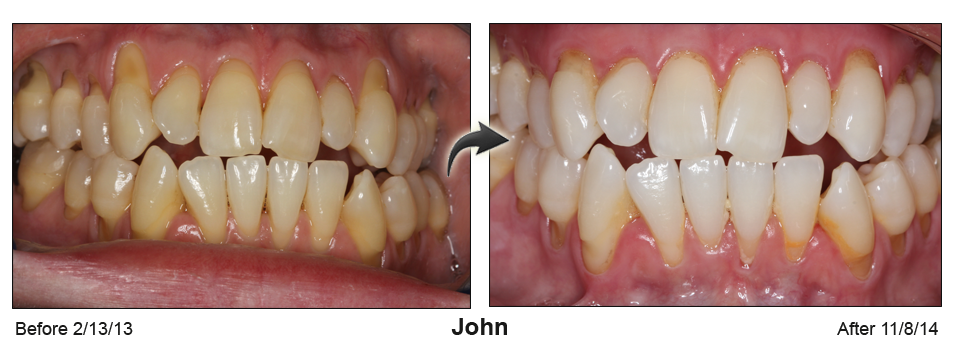 John - before and after pinhole surgical technique.