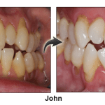 John - before and after pinhole surgical technique.