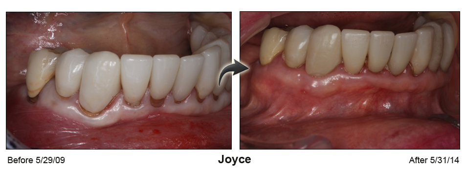 Joyce - before and after pinhole surgical technique.