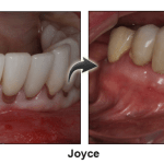 Joyce - before and after pinhole surgical technique.