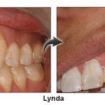 Lynda - before and after pinhole surgical technique.