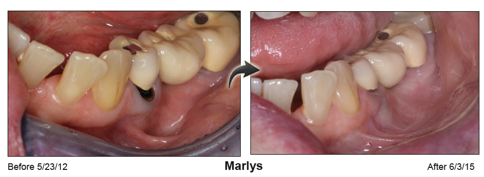 Marlys - before and after pinhole surgical technique.