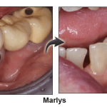 Marlys - before and after pinhole surgical technique.