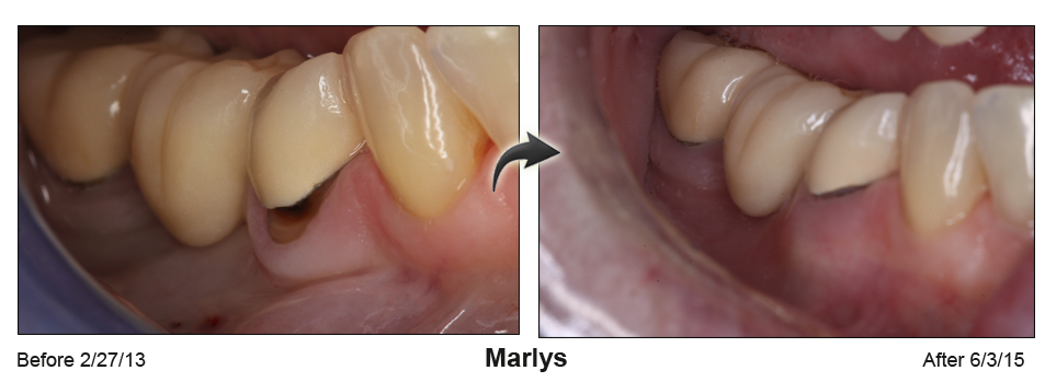 Marlys 2 - before and after pinhole surgical technique.