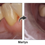 Marlys 2 - before and after pinhole surgical technique.