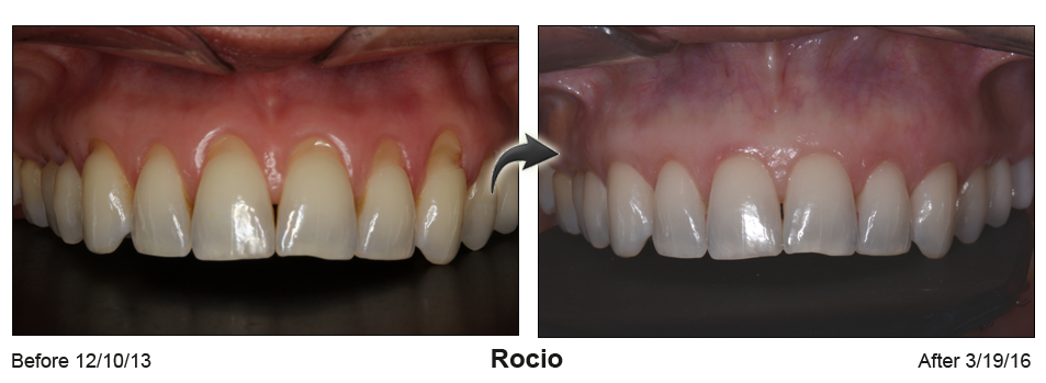 Rocio - before and after pinhole surgical technique.