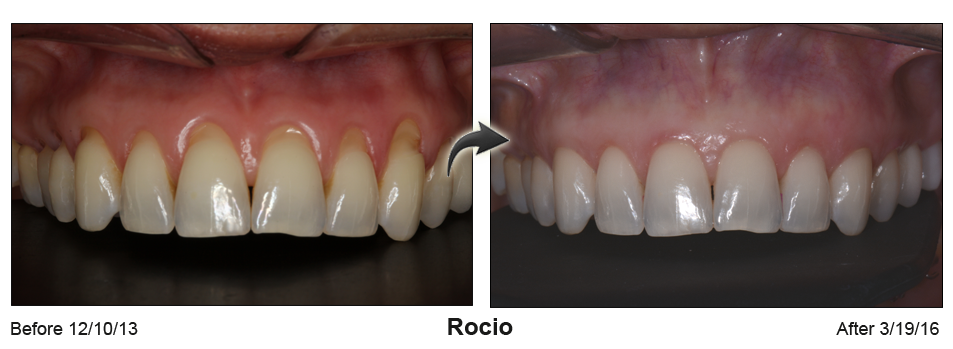 Rocio - before and after pinhole surgical technique.