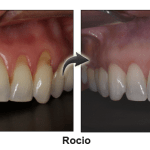 Rocio - before and after pinhole surgical technique.