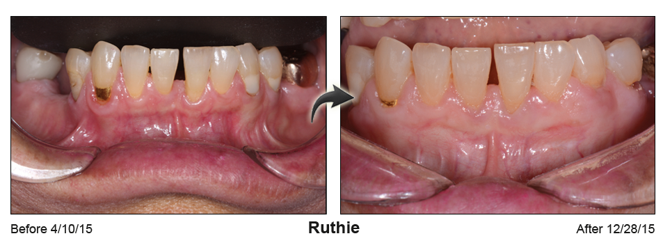 Ruthie - before and after pinhole surgical technique.