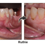 Ruthie - before and after pinhole surgical technique.