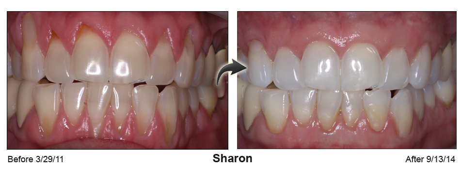 Sharon - before and after pinhole surgical technique.