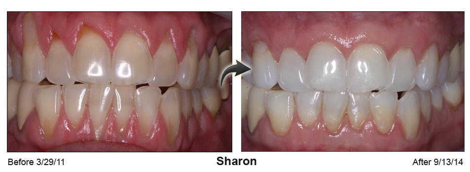 Sharon - before and after pinhole surgical technique.