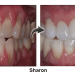 Sharon - before and after pinhole surgical technique.