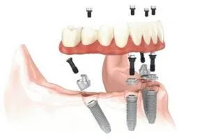 Simple graphic depicting how All-on-4 dental implants are structured and supported in the mouth.